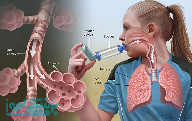 علائم،عوارض و درمان بیماری آسم  و داروهای کوتاه اثر